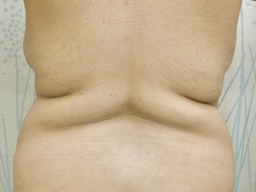 Tummy Tuck 18 Before 3