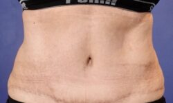 Tummy Tuck 18 After