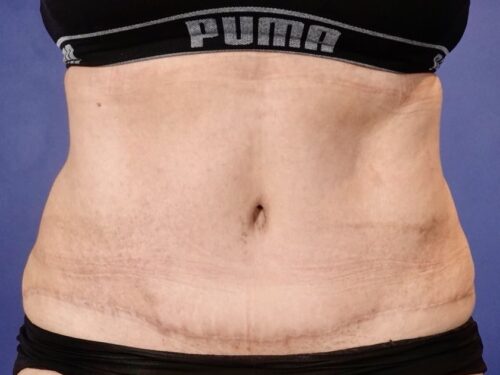 Tummy Tuck 18 After 1