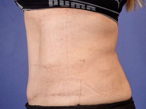 Tummy Tuck 18 After 2
