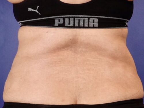 Tummy Tuck 18 After 3