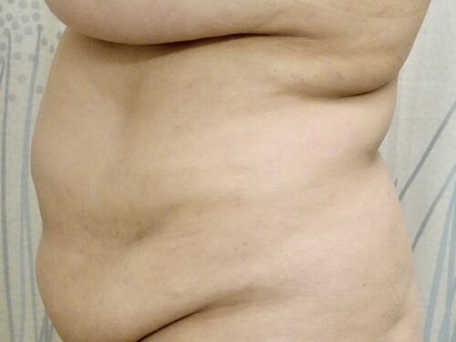 Tummy Tuck 18 Before 2