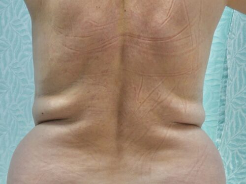 Tummy Tuck 17 Before 2