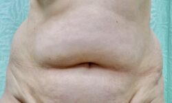 Tummy Tuck 17 Before