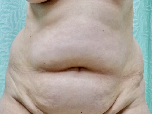 Tummy Tuck 17 Before 1