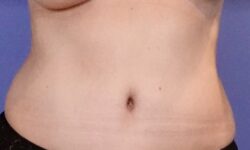 Tummy Tuck 17 After