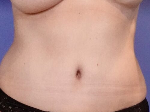 Tummy Tuck 17 After 1
