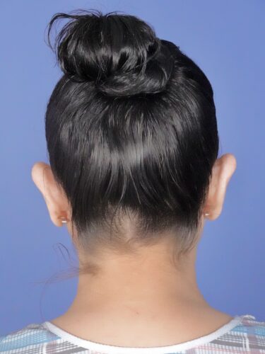 Otoplasty 02 Before 2