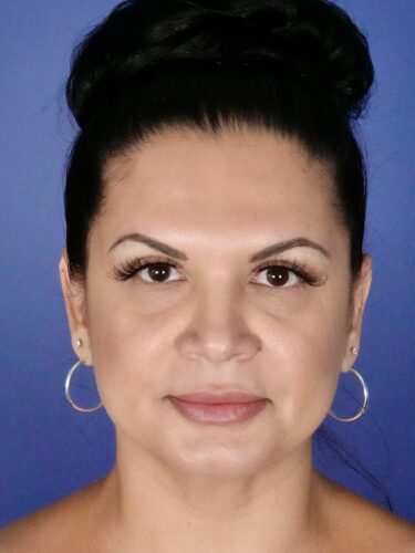 Otoplasty 02 After 1