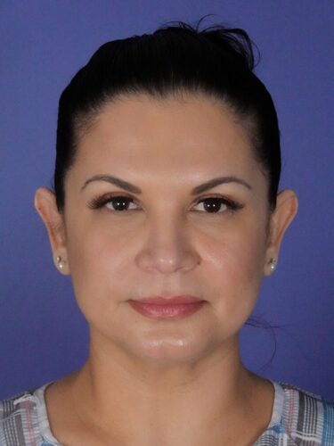 Otoplasty 02 Before 1