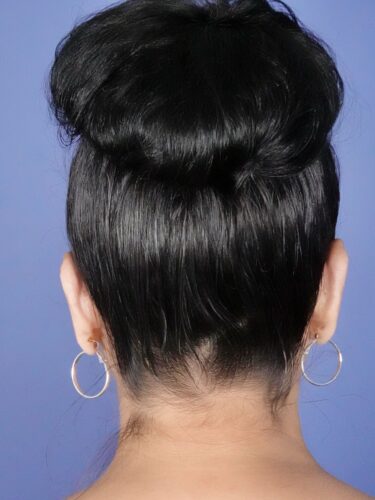 Otoplasty 02 After 2