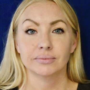 Buccal Fat Removal 10 After 1