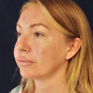 Buccal Fat Removal 10 Before 2