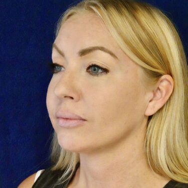 Buccal Fat Removal 10 After 2