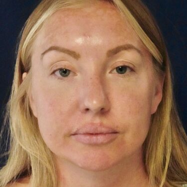 Buccal Fat Removal 10 Before 1