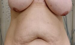 Mommy Makeover 01 Before