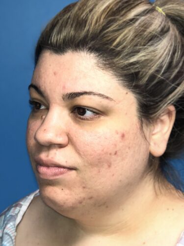 FaceTite / Lipo of Neck 07 Before 2