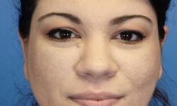 FaceTite / Lipo of Neck 07 After