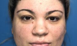 FaceTite / Lipo of Neck 07 Before