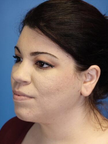 FaceTite / Lipo of Neck 07 After 2