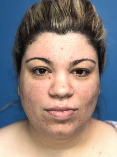 FaceTite / Lipo of Neck 07 Before 1
