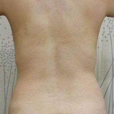 Mommy Makeover 02 Before 3