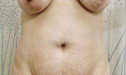 Mommy Makeover 02 Before