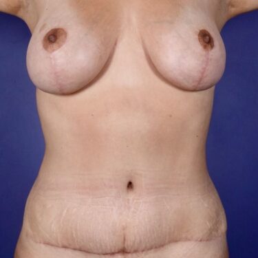 Mommy Makeover 02 After 1