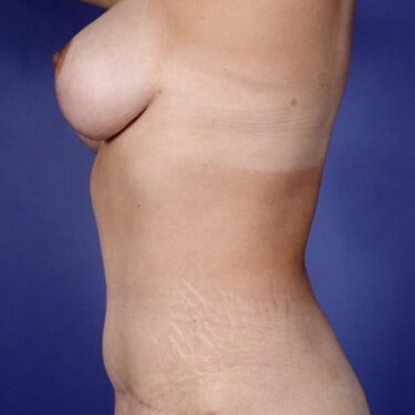 Mommy Makeover 02 After 2