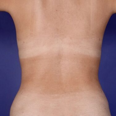 Mommy Makeover 02 After 3