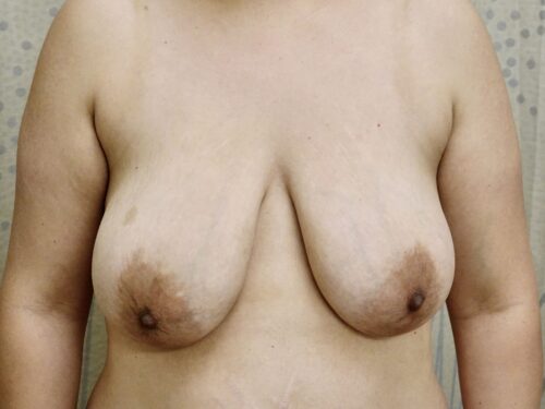 Breast Lift 11 Before 1