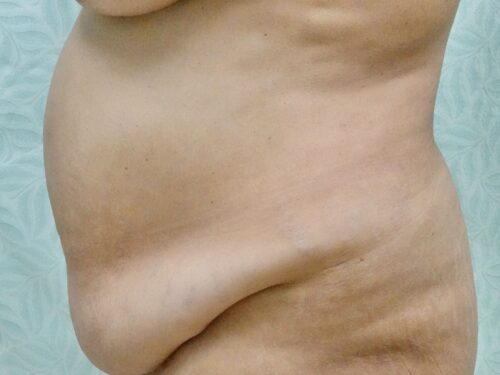 Tummy Tuck 19 Before 2