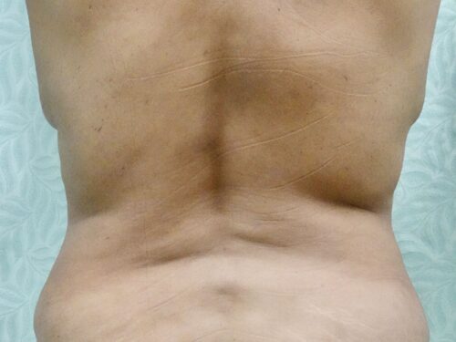 Tummy Tuck 19 Before 3