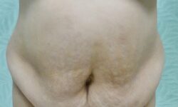 Tummy Tuck 19 Before