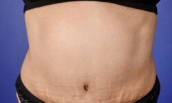 Tummy Tuck 19 After