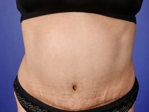 Tummy Tuck 19 After 1