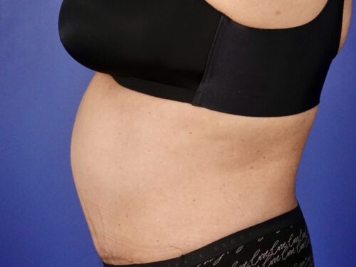 Tummy Tuck 19 After 2