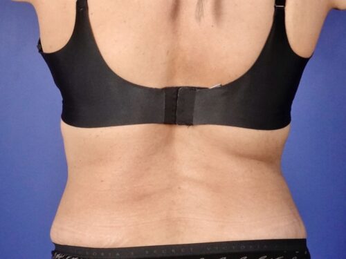 Tummy Tuck 19 After 3