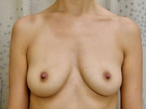 Breast Augmentation 25 Before 1