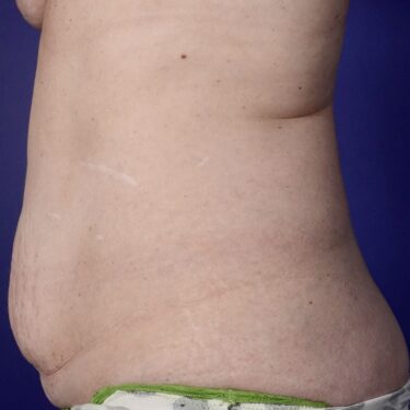 BodyTite 09 Before 2