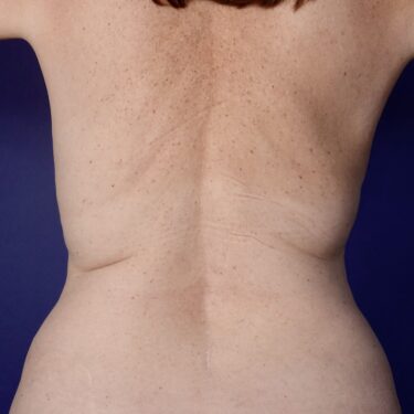 BodyTite 09 Before 3