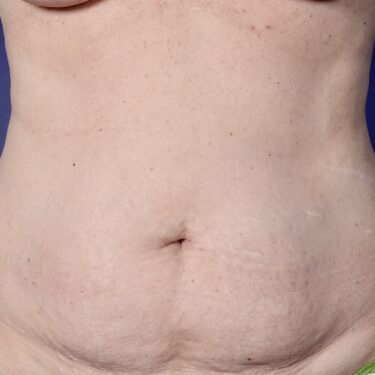 BodyTite 09 Before 1