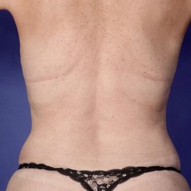 BodyTite 09 After 3
