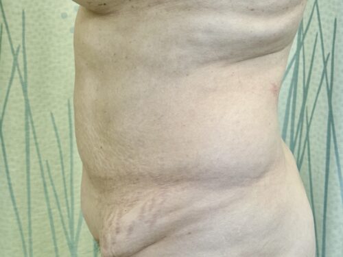 BodyTite 10 Before 2