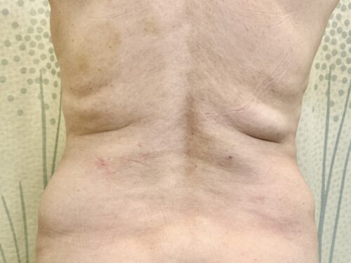 BodyTite 10 Before 1