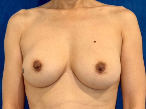 BREAST IMPLANT EXCHANGE 09 Before 1