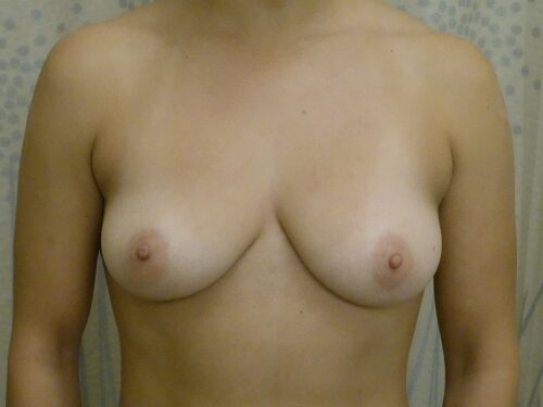 Breast Augmentation 26 Before 1
