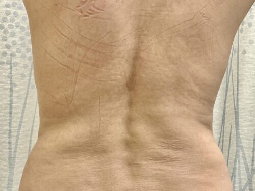 BodyTite 11 Before 2