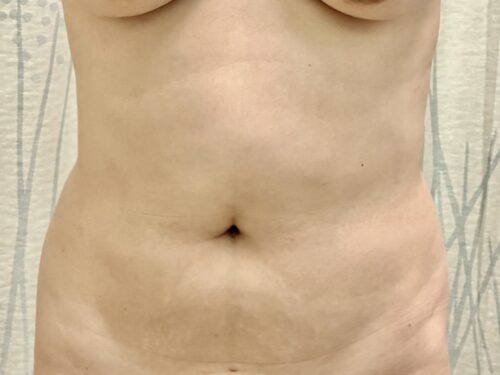 BodyTite 11 Before 1