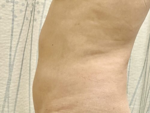 BodyTite 11 Before 3